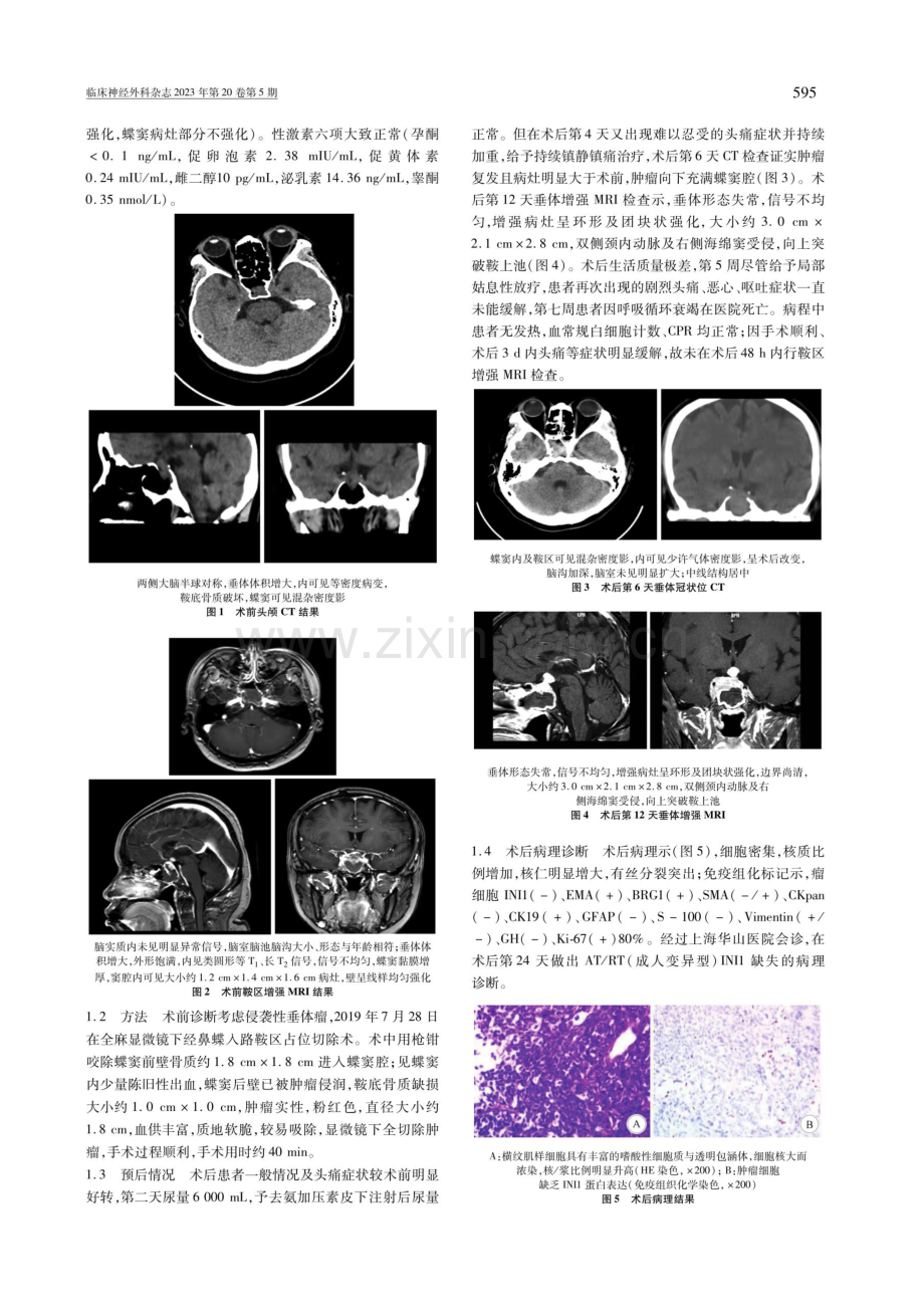 成人鞍区非典型畸胎样_横纹肌样瘤一例.pdf_第2页