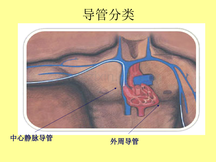 输液港的维护.pptx_第3页