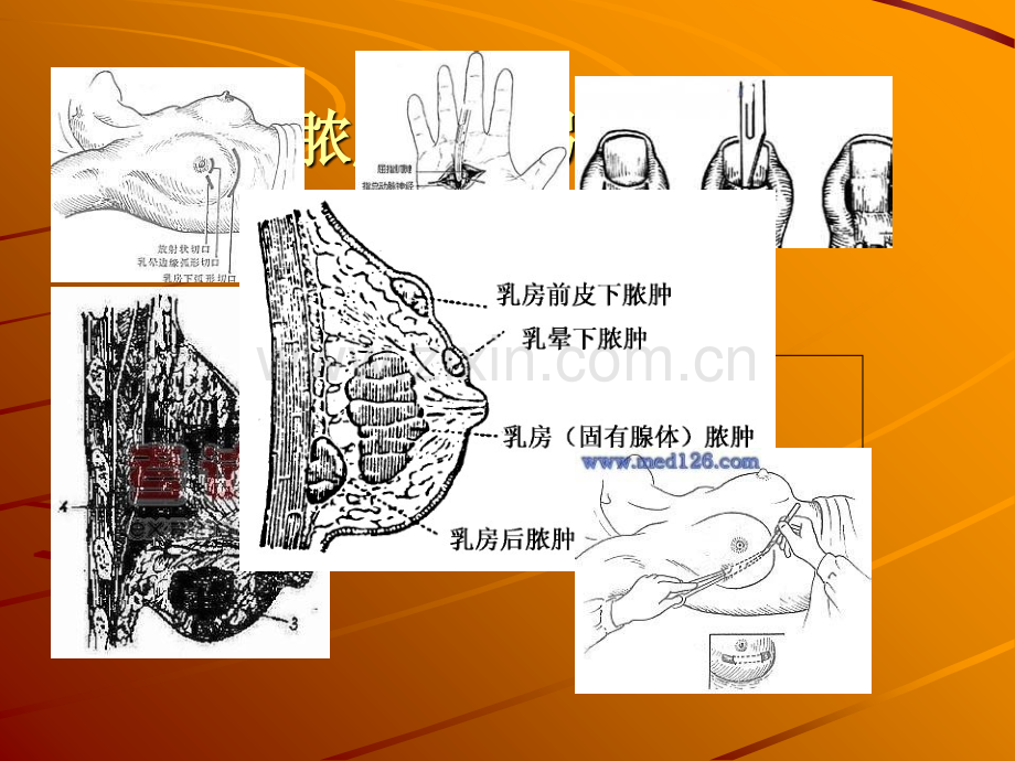 脓肿切开、换药、拆线.ppt_第1页