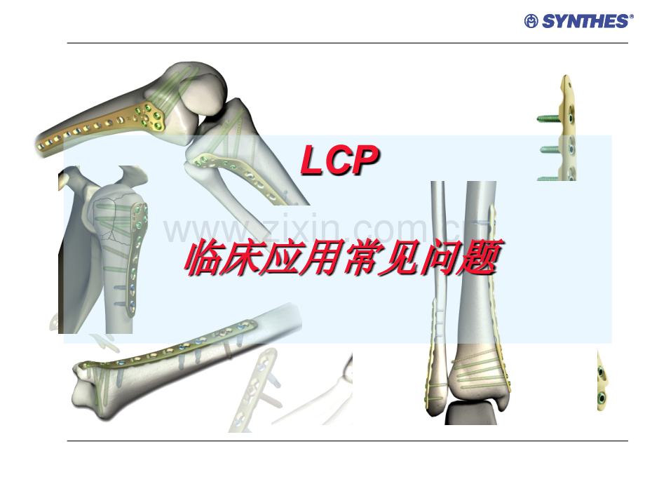 锁定内固定系统临床应用常见问题LCP-Questions.ppt_第1页