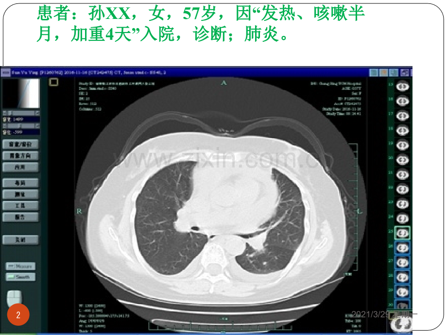 胸腔积液详解.ppt_第2页