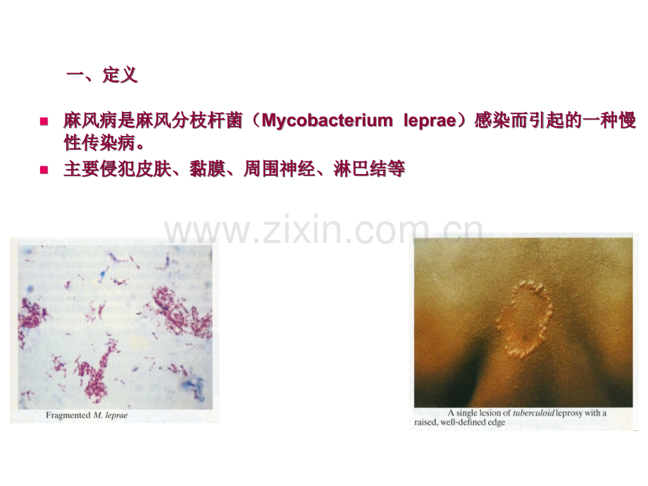 麻风病临床诊断和鉴别.ppt_第3页