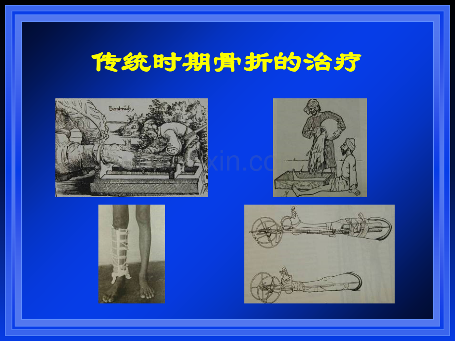 骨折治疗的AO原则与BO理念.ppt_第3页