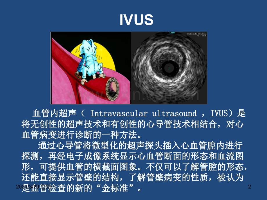 血管内超声在冠脉介入中的临床应用.ppt_第2页