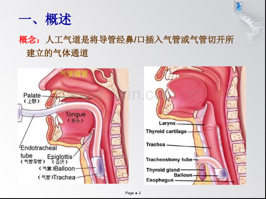 人工气道管理新进展.ppt_第3页