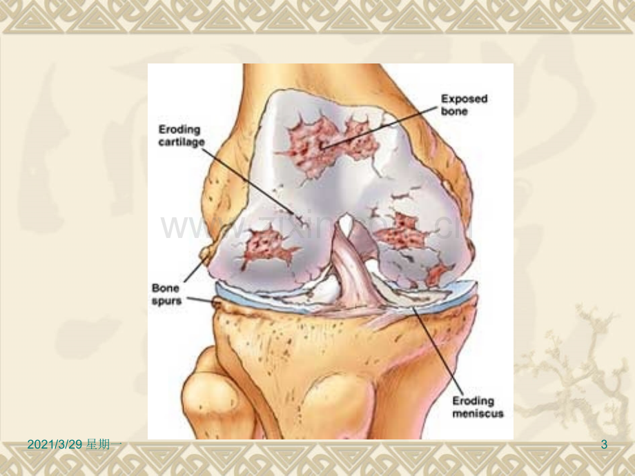 骨性关节炎临床和影像诊断.ppt_第3页