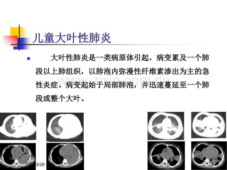 大叶性肺炎的分期治疗.ppt_第2页