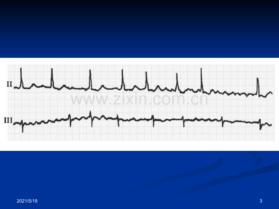 房颤的心电图诊断.ppt_第3页