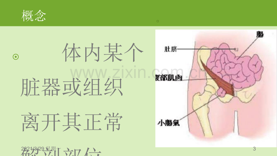 腹股沟疝护理教学查房..ppt_第3页