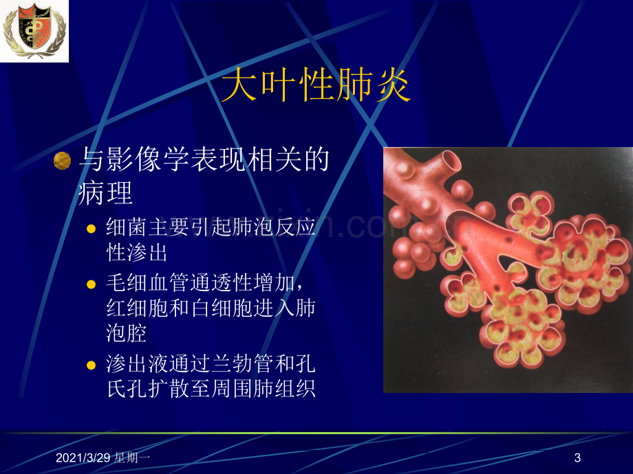 肺部炎症影像诊断.ppt_第3页