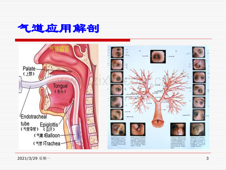 人工气道护理.ppt_第3页