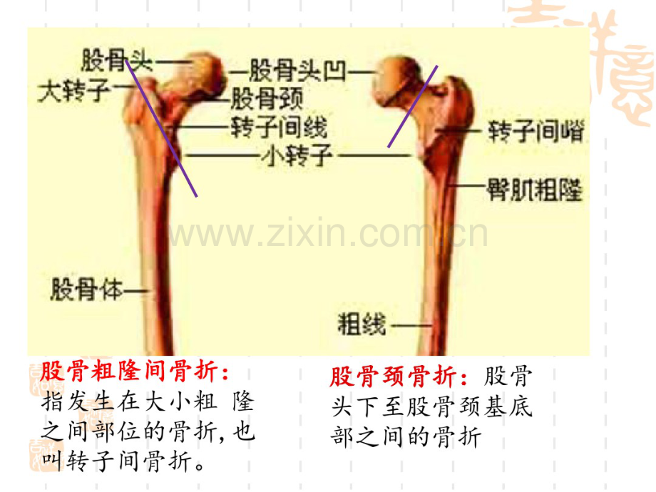 股骨近端骨折内固定选择策略.pdf_第2页