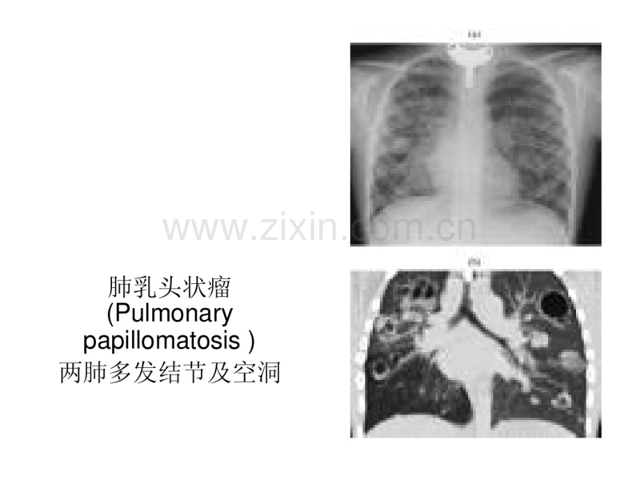 肺少见病的CT诊断.pdf_第3页