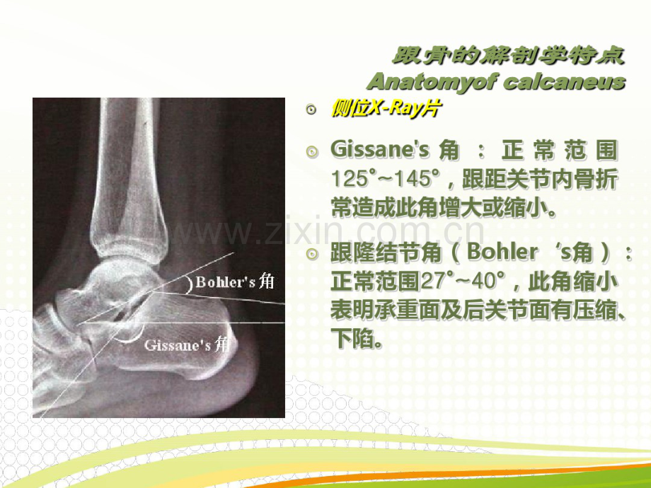 跟骨骨折的分型与治疗讲座.pdf_第3页