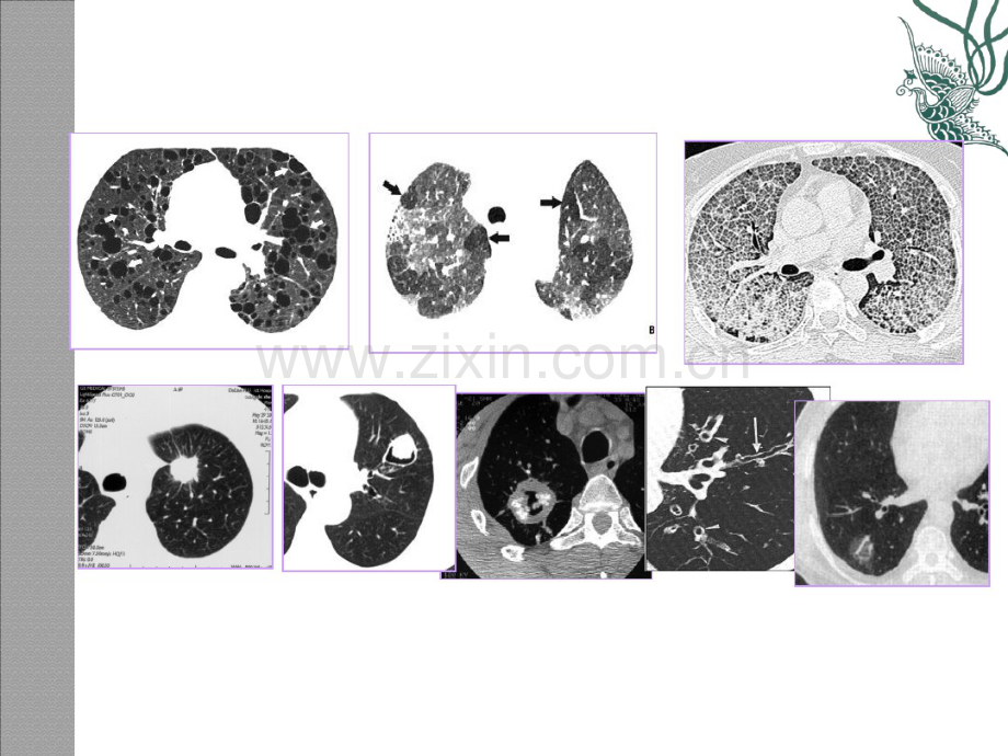 肺疾病的CT征象分析象.pdf_第2页