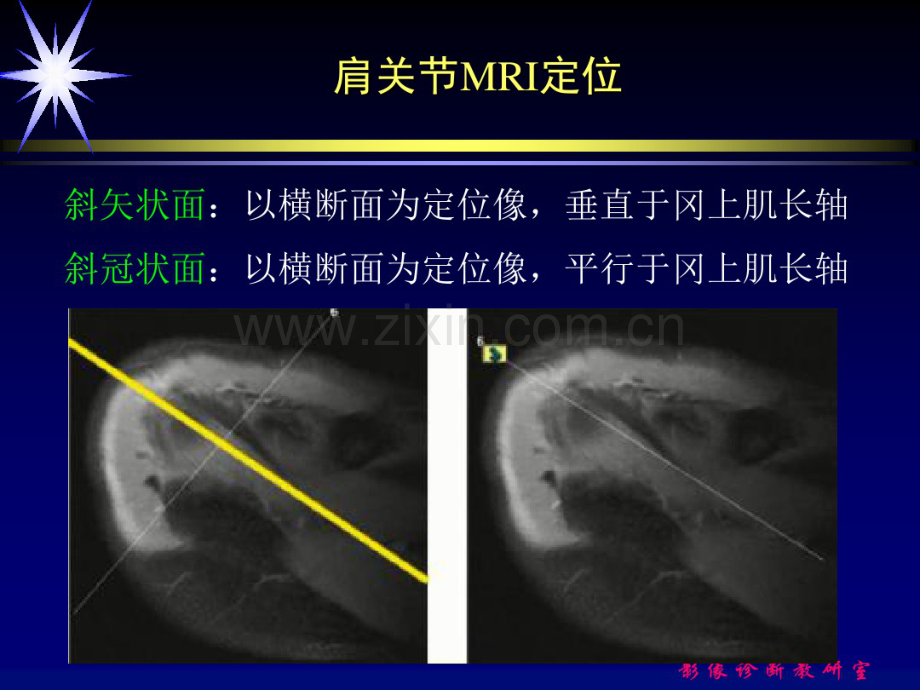 肩关节损伤的MRI诊断.pdf_第3页