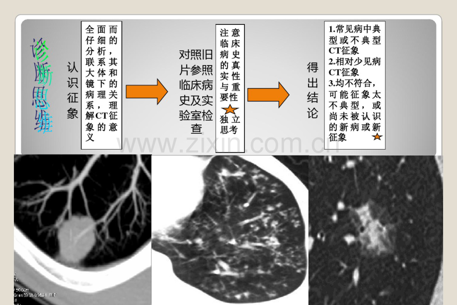 肺特殊CT征象--孙国鹏.pdf_第3页