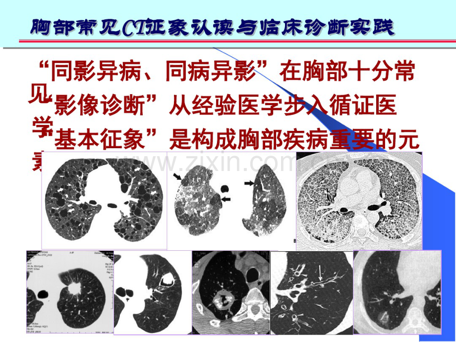 肺部CT十大征象.pdf_第2页