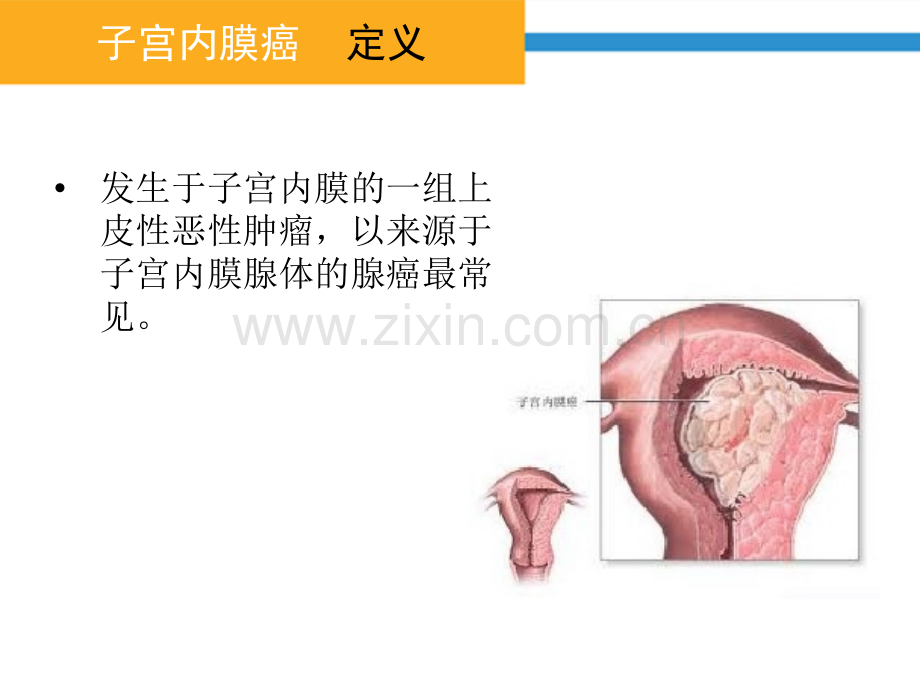 子宫内膜癌病人护理-张紫欢.ppt_第2页