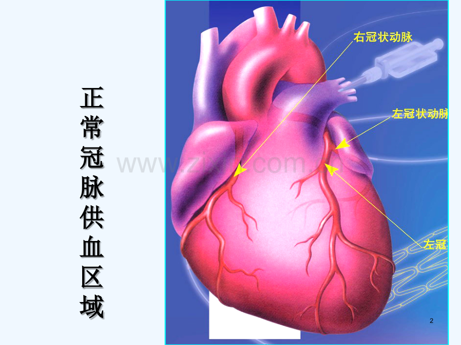 《急性心肌梗死》课件-PPT.ppt_第2页