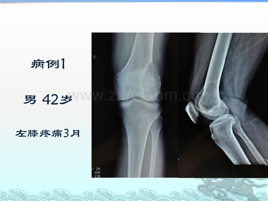 骨巨细胞瘤影像诊断.pdf_第2页