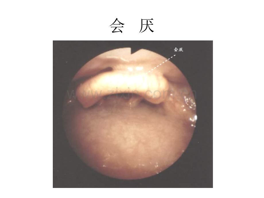 气管镜图谱(医学PPT课件).ppt_第1页