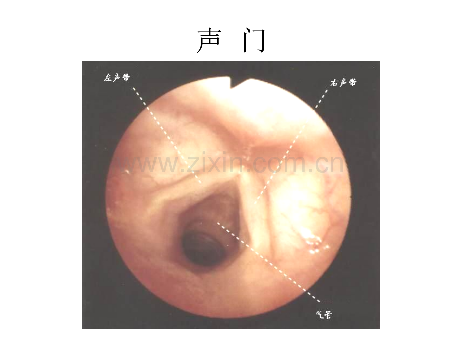 气管镜图谱(医学PPT课件).ppt_第3页