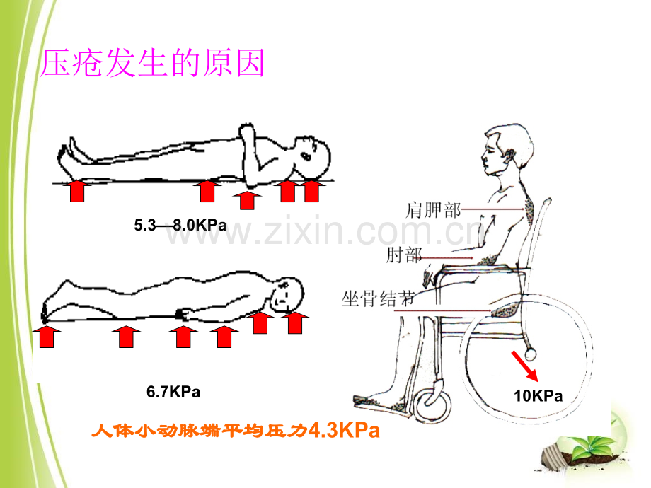 压疮幻灯片(ppt文档).ppt_第3页