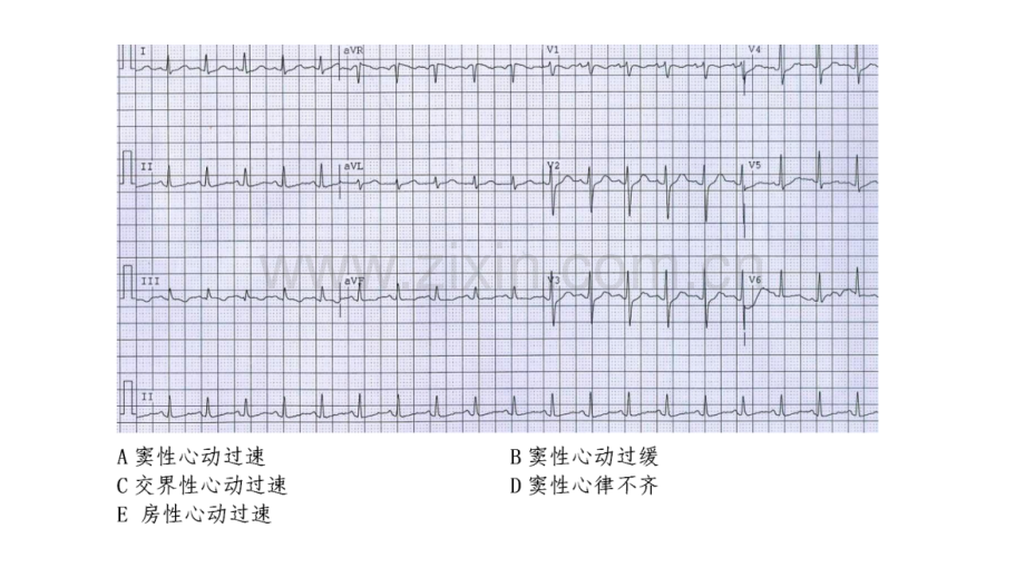 心电图练习题(带图有答案).ppt_第1页