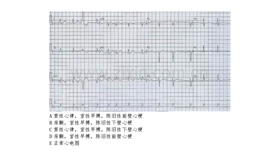 心电图练习题(带图有答案).ppt_第3页