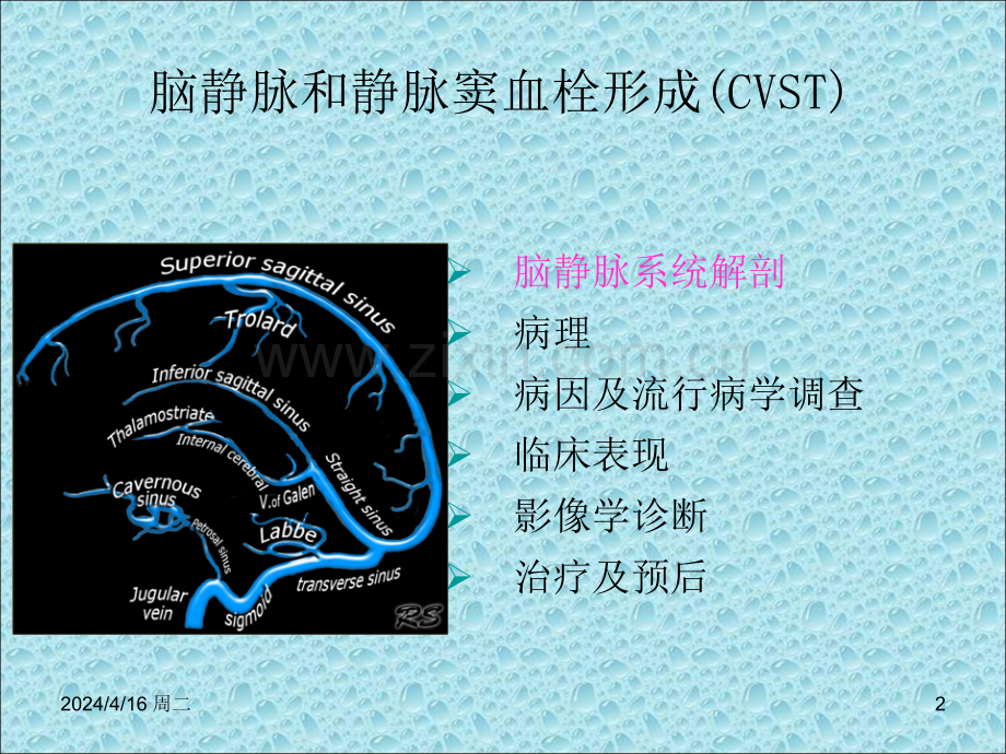 颅内静脉窦血栓形成.ppt_第2页