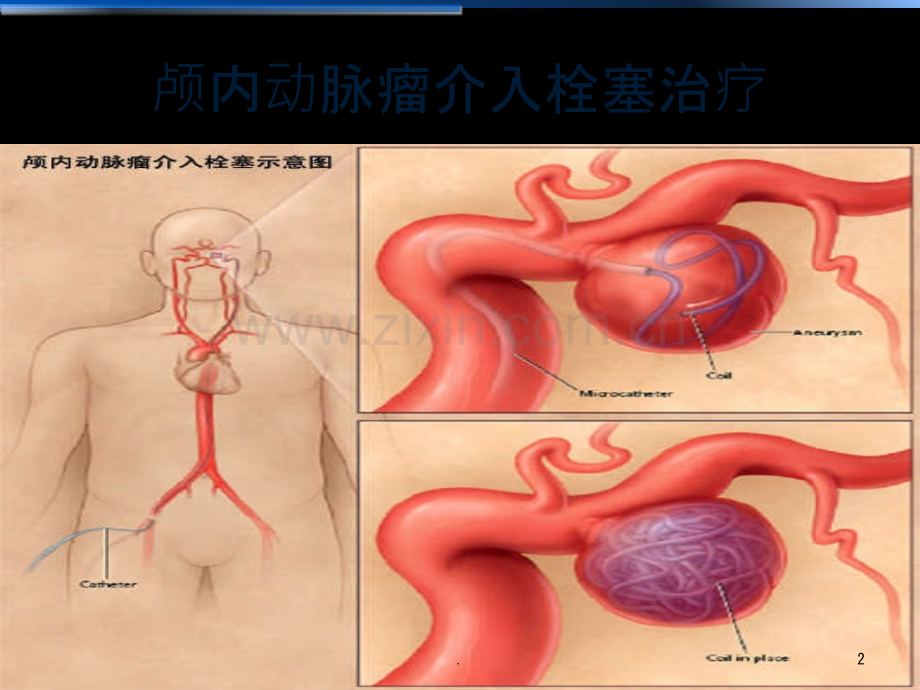 颅内动脉瘤介入栓塞治疗——麻醉管理课件.ppt_第2页