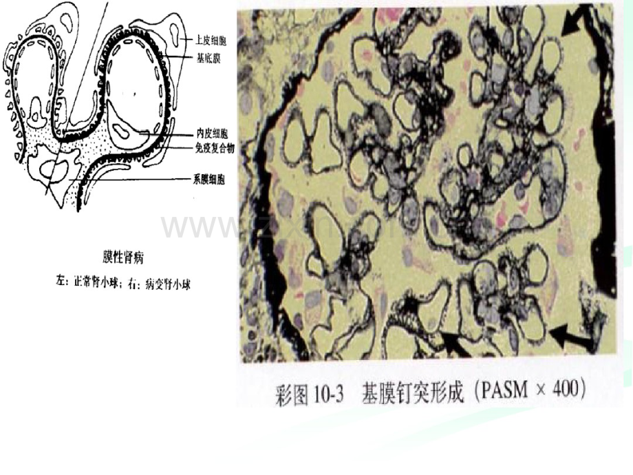 膜性肾病.pdf_第3页