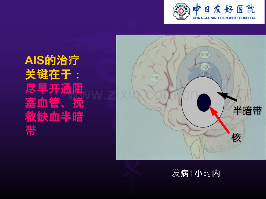 静脉溶栓的护理.ppt_第3页