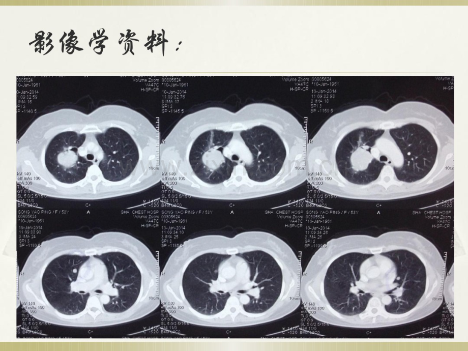 肺良性转移性平滑肌瘤病的诊治.pdf_第3页