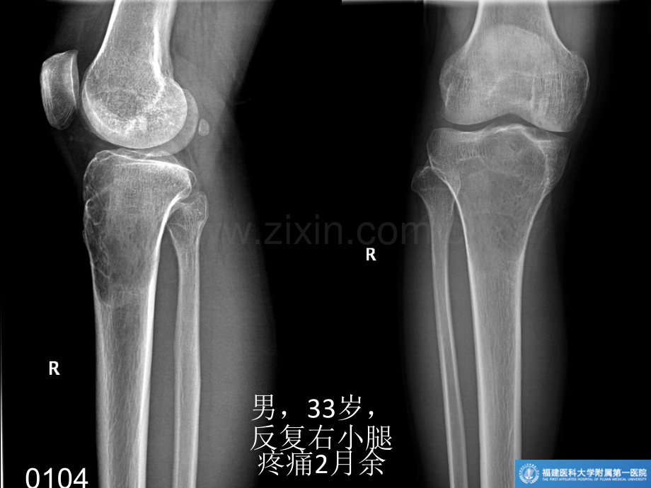 长骨良性纤维组织细胞瘤.ppt_第1页