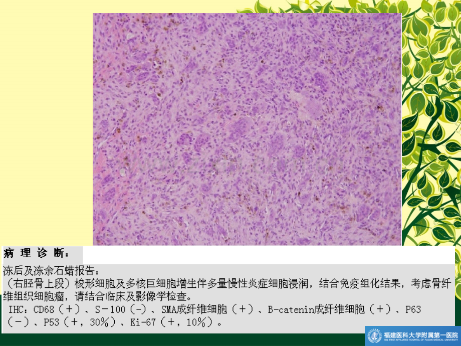 长骨良性纤维组织细胞瘤.ppt_第2页