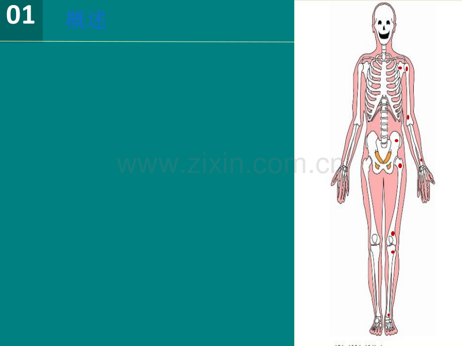 尺骨远端遗传性多发性骨软骨瘤病.pptx_第3页