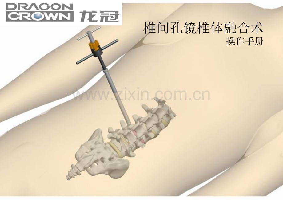 椎间孔镜可膨胀式椎间融合器操作手册.pptx_第1页