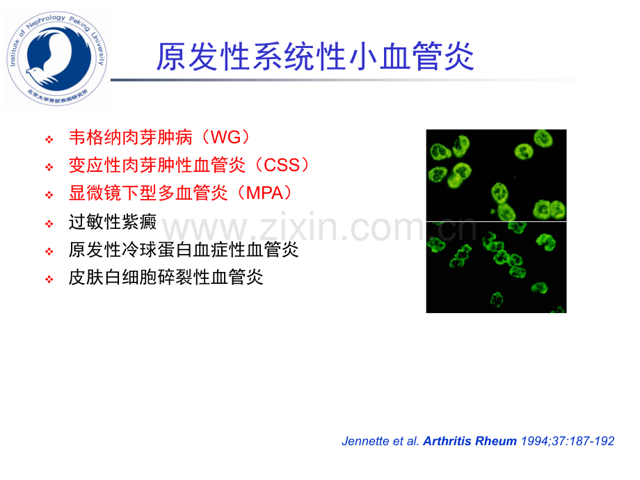 医学anca相关小血管炎诊断和治疗进展.pptx_第3页