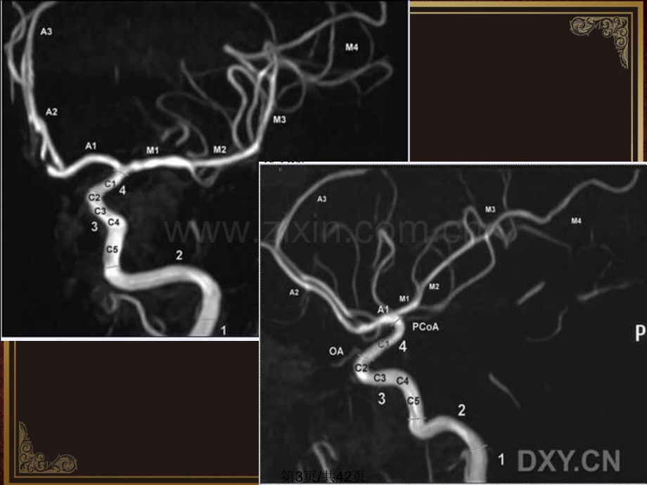 大脑中动脉.pptx_第3页