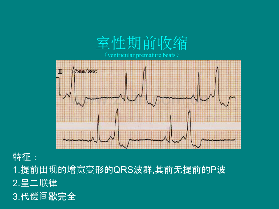 内科学——心律失常三.ppt_第3页