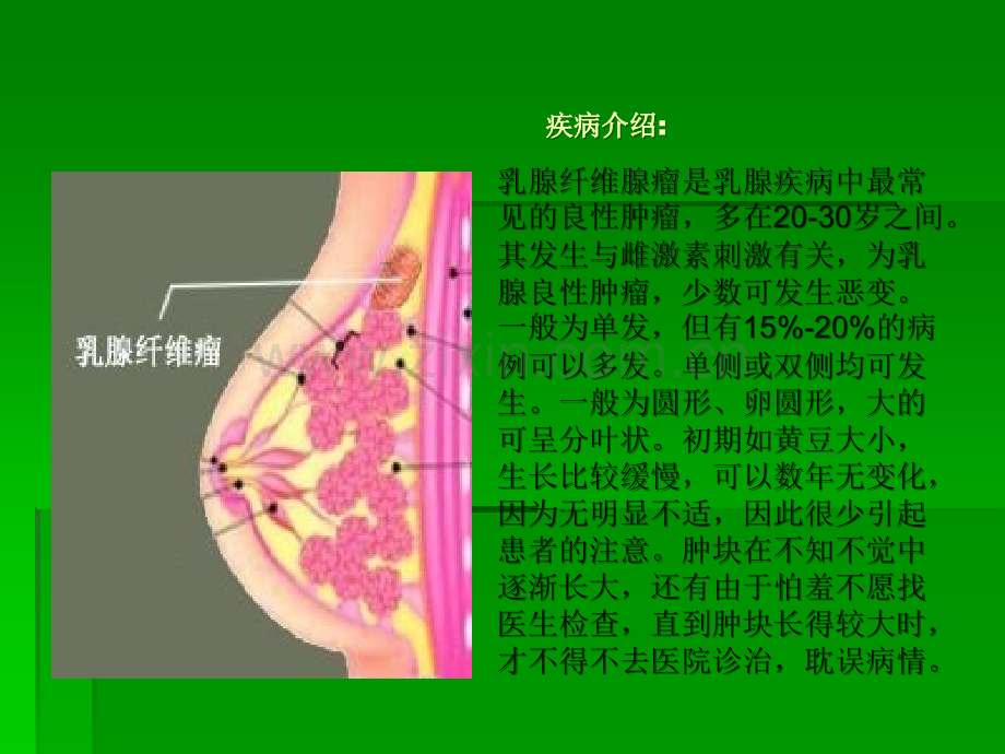 乳腺纤维腺瘤.ppt_第2页