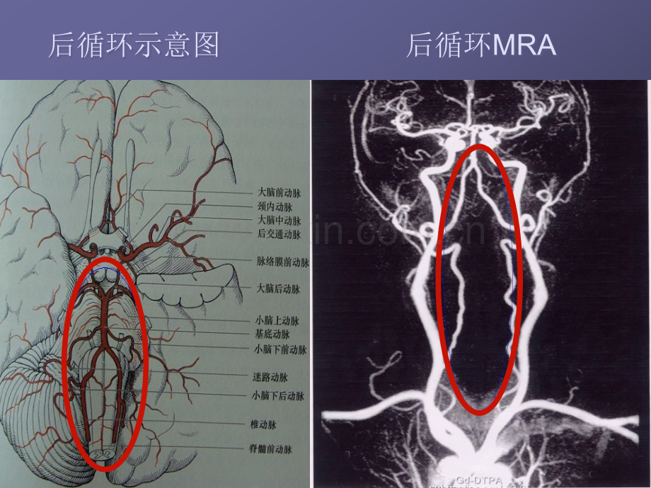 后循环缺血.ppt_第3页