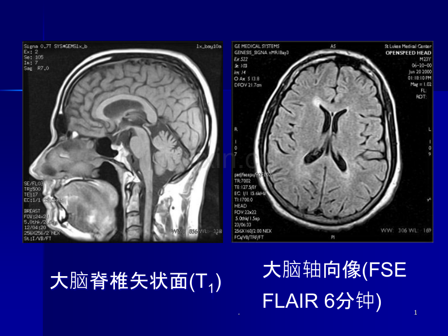 临床医学课件-脑MRI-磁共振.ppt_第1页