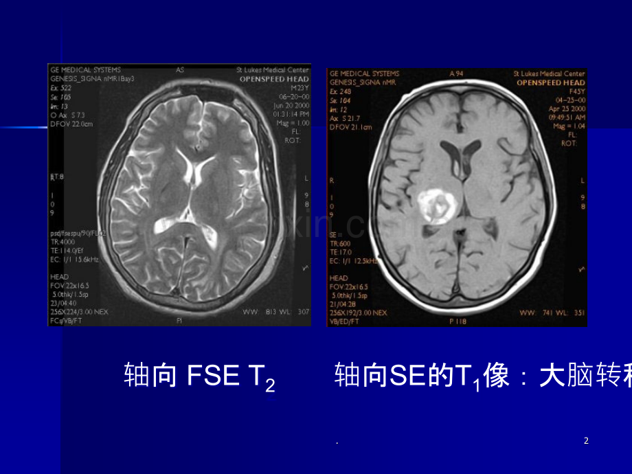 临床医学课件-脑MRI-磁共振.ppt_第2页