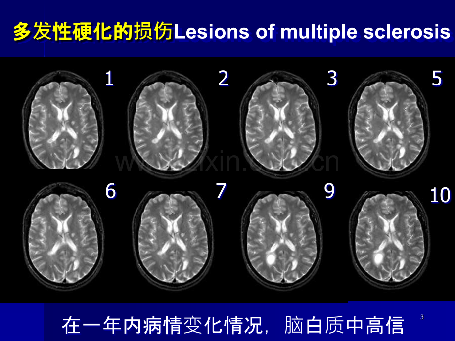 临床医学课件-脑MRI-磁共振.ppt_第3页