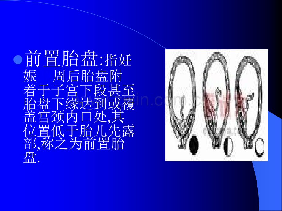 前置胎盘与胎盘早剥的区别.ppt_第3页