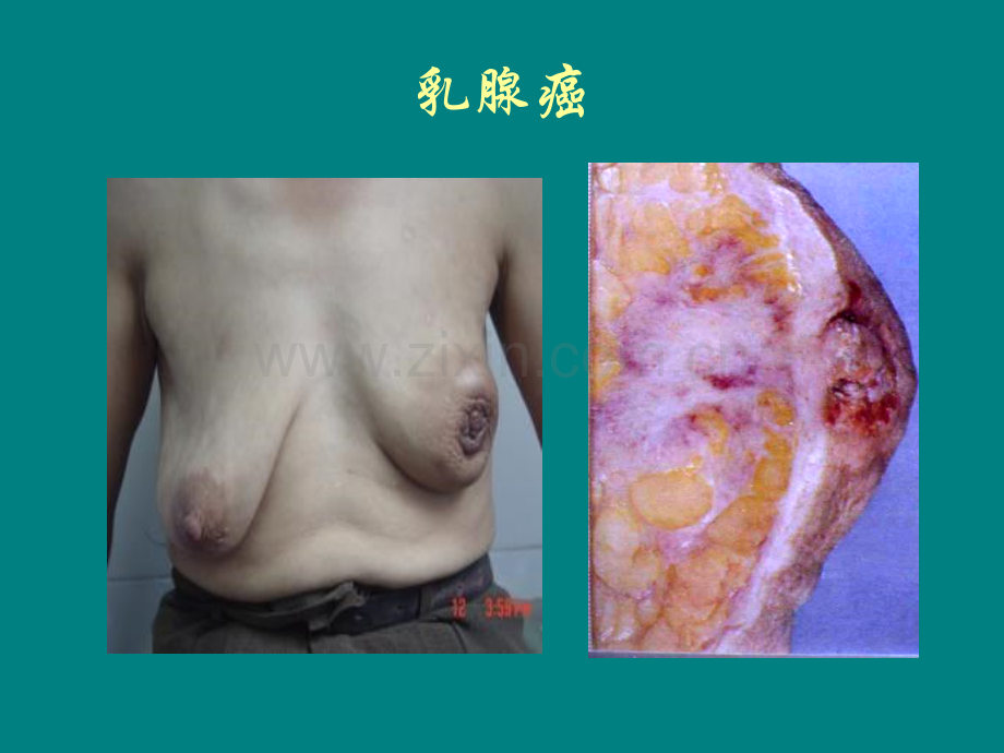 乳腺癌的发病机制、临床表现与病理学.ppt_第2页