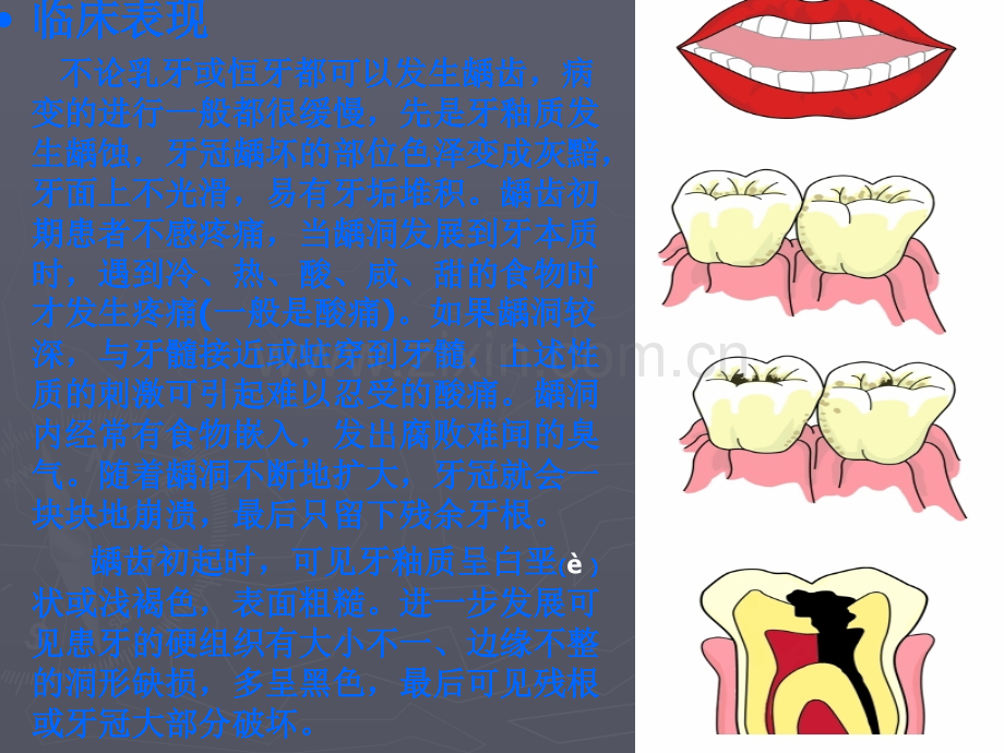 口腔常见疾病.ppt_第3页